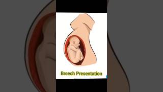 Breech presentation vs cephalic presentation [upl. by Orabla307]