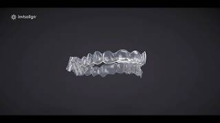 Invisalign Treatment With Mandibular Advancement [upl. by Eveiveneg751]