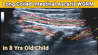 Ultrasound  Long  Coiled Ascaris Worm  in Small Intestine of 8yrs old Child [upl. by Esinehc623]