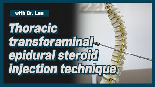 TThoracic transforaminal epidural steroid injection technique [upl. by Cleodal250]