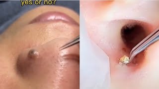 Ultimate Pimple Popping Compilation 2024 Satisfying Cyst amp Blackhead Removal [upl. by Bonar]