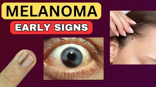 6 Weird Signs That You Have Melanoma [upl. by Risay91]