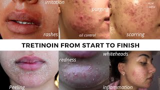 TRETINOIN BEFORE AND AFTER  FULL TRETINOIN EXPERIENCE my journey from start to end Adult Acne [upl. by Armilda]