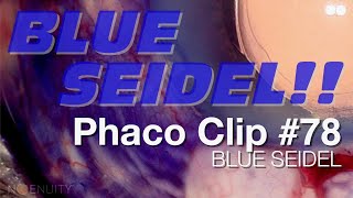 Phaco Clip 78  Blue Seidel [upl. by Llet490]