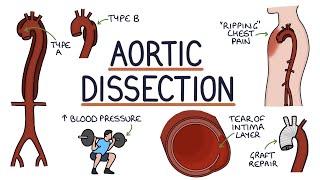 Understanding Aortic Dissection [upl. by Clarhe783]