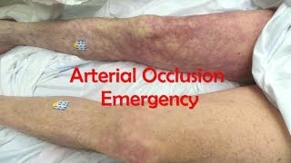 Acute Complete Occlusion of the Leg Arteries [upl. by Dammahum]