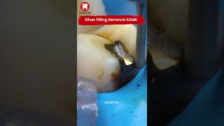 Silver Filling Removal 4k shorts [upl. by Betthel]