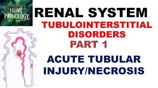 ACUTE TUBULAR INJURYNECROSIS or ACUTE KIDNEY INJURY  Pathology [upl. by Onitnas]