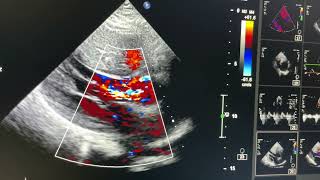 Hypertrophic Cardiomyopathy Non obstructive [upl. by Nolana340]