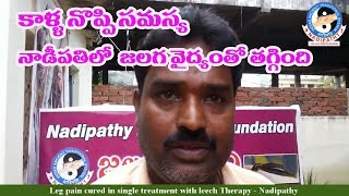 Leg pain cured in single treatment with leech Therapy  Nadipathy [upl. by Sperling165]