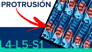 PROTRUSION L4L5 y L5S1 😤 ¿Hernia de disco o protrusion discal [upl. by Ilat]