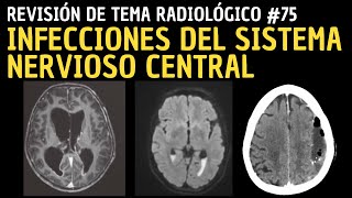 Revisión de Tema 75 Infecciones del sistema nervioso central SNC [upl. by Ennazzus]