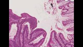 Histopathology ColonTubular adenoma [upl. by Ydal778]