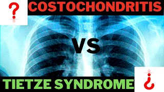 Tietze Syndrome OR Costochondritis [upl. by Yrrad]