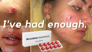 Why Im Starting Accutane Isotretinoin For My Cystic Acne 40mg Accutane Journey accutane acne [upl. by Ahsineg325]