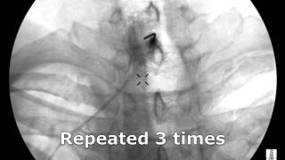 Cervical Interlaminar Epidural Steroid Injection  ThePainSourcecom [upl. by Alfi443]