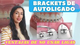 Brackets de Autoligado Ventajas de NO usar ligas [upl. by Aitselec587]