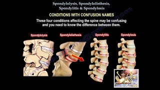 Degenerative Spondylolisthesis  Patient Animation [upl. by Aubert]