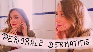 So wirst du deine Periorale Dermatitis los [upl. by Etnoid]