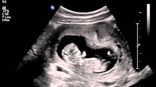 Jumping womb dancer baby ultrasound scan [upl. by Ailhat]