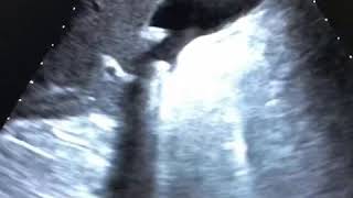 Litiasis vesicular Quiste renal Ecografia abdominal Vesicular lithiasis Renal cyst ultrasound [upl. by Vaclav]