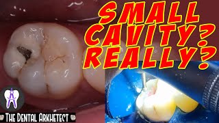 Molar Tooth Caries Removal and Restoration Pasta sa Bagang42 [upl. by Chemarin206]