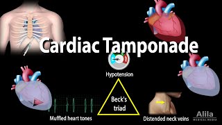 Cardiac Tamponade Pathophysiology Etiology Symptoms Diagnosis and Management Animation [upl. by Bobbee]