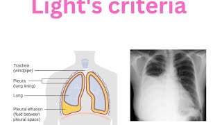 Pleura  Pleural effusion  Lights criteria  Transudate  Exudate Empyema [upl. by Marla]