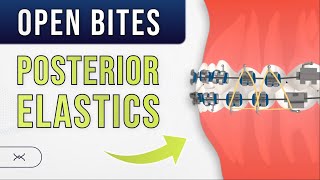 Anterior OPEN BITE  Posterior Elastics  Orthodontic Treatment [upl. by Ahsiliw]