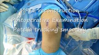 Patella dislocation MPFL reconstruction DrBancha Chernchujitwmv [upl. by Grose944]