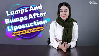 How to Get Rid of Lumps After Liposuction  AriaMedTour [upl. by Orford]