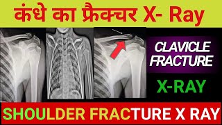 How to read shoulder fracture x ray  कंधे का फ्रैक्चर x ray  clavicle fracture x ray Techcpd [upl. by Noerb]