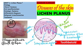 Oral Lichen planus Part 1 Causes Pathogenesis Clinical features Skin lesions [upl. by Omari]