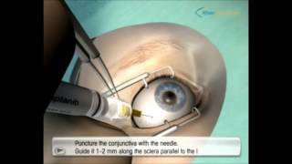 Diabetic Retinopathy Intravit Injection Video 3 [upl. by Eahc]