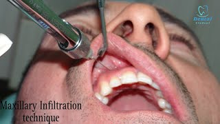 Maxillary Infiltration anesthesia technique  Local anesthesia for maxillary teeth [upl. by Airekahs839]