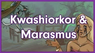 Kwashiorkor vs Marasmus  Nutrition Mnemonic [upl. by Elleirol]