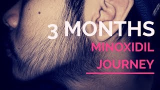 Week 12 Minoxidil Beard Journey [upl. by Elenahc]