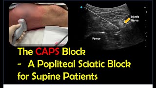 Lateral Popliteal Sciatic Block for Supine Patients CAPS block [upl. by Konrad]