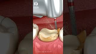 Caries Removal and Crown Placement  Your Path to Dental Health tooth 3D animation [upl. by Dlonyer]