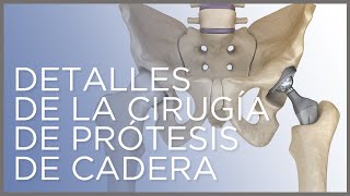 Detalles de la cirugía de prótesis de cadera Dr Ángel Villamor [upl. by Nnylyma138]