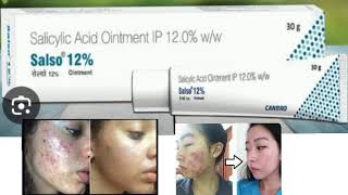 Salso 12 Ointment Salicylic Acid Ointment IP 120 ww [upl. by Lyrehs]