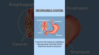 Esophagus cancer I Treatment for Esophagus cancer in Delhi [upl. by Borlow]