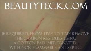 Hypertrophic scar removal using voltaic plasma The BeautyTeck [upl. by Hui808]