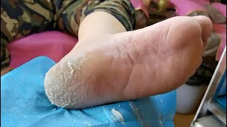 Cracked heel treatment 4 Massive dead skin were removed Dry scaly skin treatment Callus removal [upl. by Donnell873]