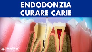 Endodonzia – Curare carie profonda © [upl. by Wrigley]