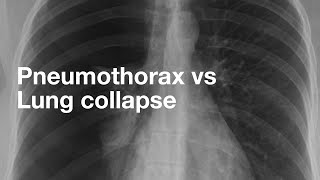 Pneumothorax vs Lung Collapse [upl. by Willumsen596]