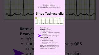 Sinus Tachycardia EKG ECG Rhythm Nursing Review in 60 Seconds shorts ecg nursing [upl. by Bekaj]