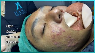 Big Cystic Acne Blackheads Extraction Blackheads amp Milia Whiteheads Removal Pimple Popping [upl. by Crin926]