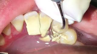 Houston Cosmetic DentistTartar Tartar Tartar How we remove it [upl. by Yelsgnik974]