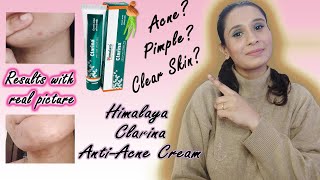 Himalaya Clarina AntiAcne Cream Review Hindi How to get clear skin HOW TO GET RID OF ANCE FAST [upl. by Avevoneg]